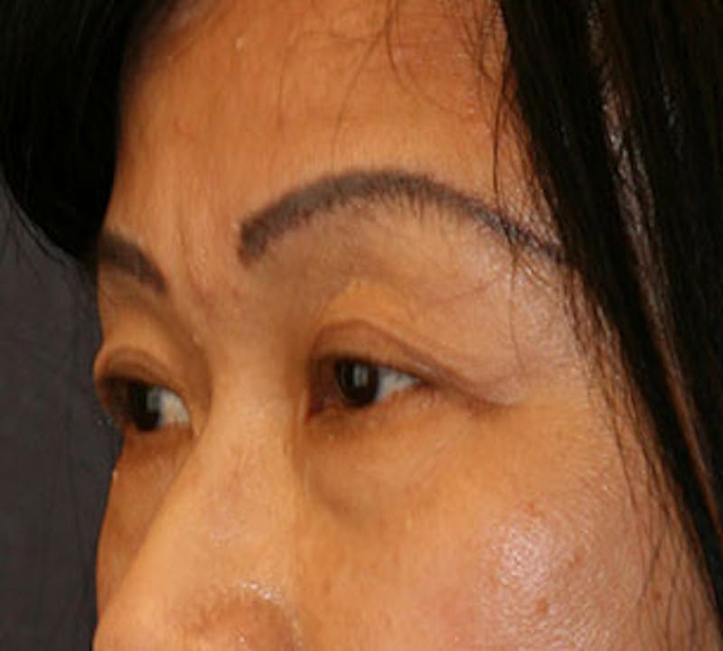 Lower Blepharoplasty Before & After Gallery - Patient 106569018 - Image 5