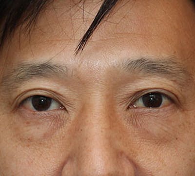 Lower Blepharoplasty Before & After Gallery - Patient 106569019 - Image 1