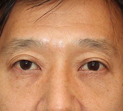 Lower Blepharoplasty Before & After Gallery - Patient 106569019 - Image 2