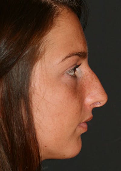 Rhinoplasty Before & After Gallery - Patient 106569149 - Image 1