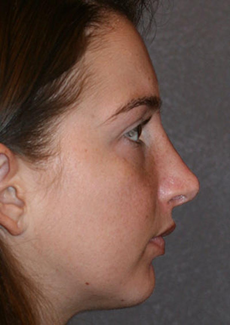 Rhinoplasty Before & After Gallery - Patient 106569149 - Image 2