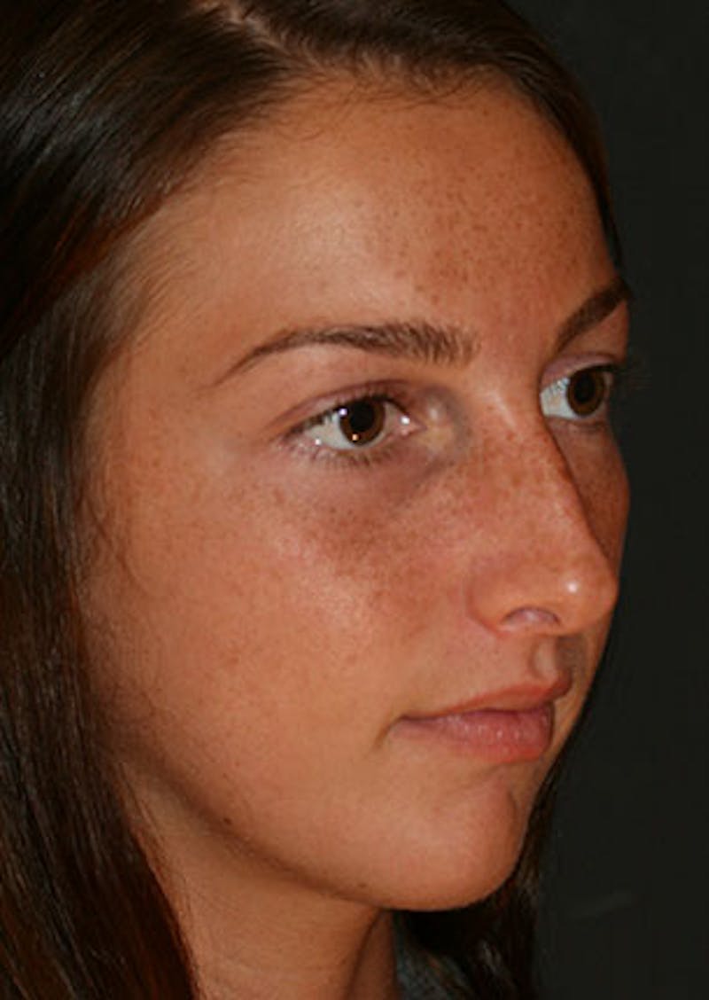 Rhinoplasty Before & After Gallery - Patient 106569149 - Image 3