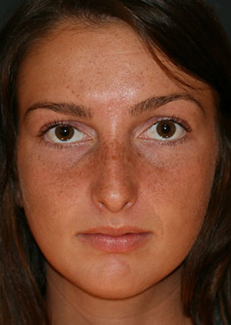 Rhinoplasty Before & After Gallery - Patient 106569149 - Image 5