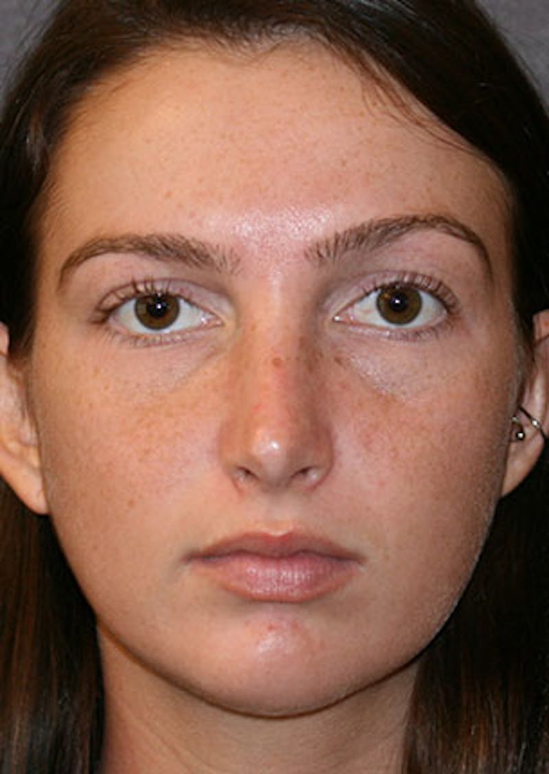 Rhinoplasty Before & After Gallery - Patient 106569149 - Image 6