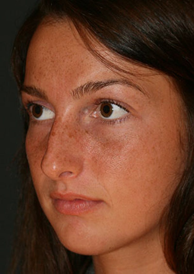 Rhinoplasty Before & After Gallery - Patient 106569149 - Image 7