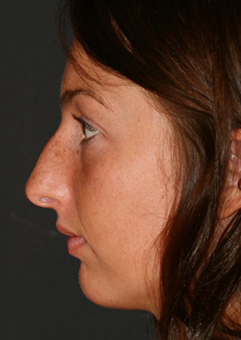 Rhinoplasty Before & After Gallery - Patient 106569149 - Image 9