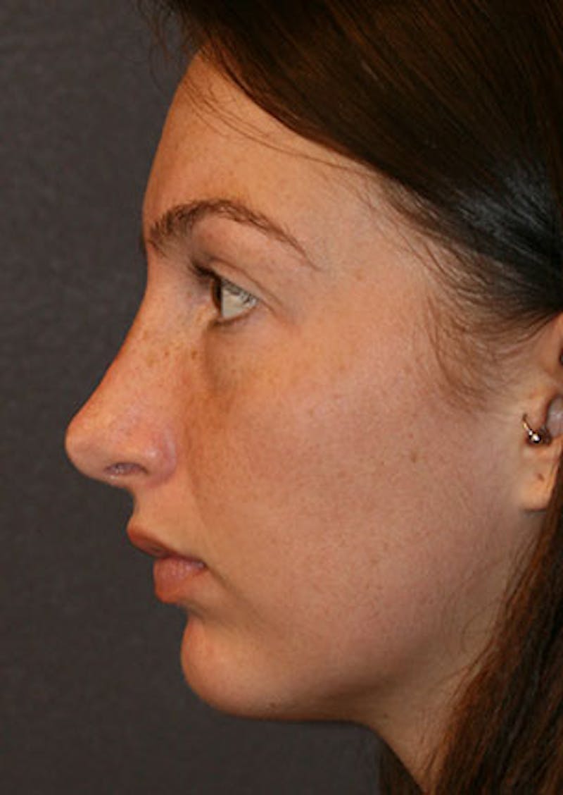 Rhinoplasty Before & After Gallery - Patient 106569149 - Image 10