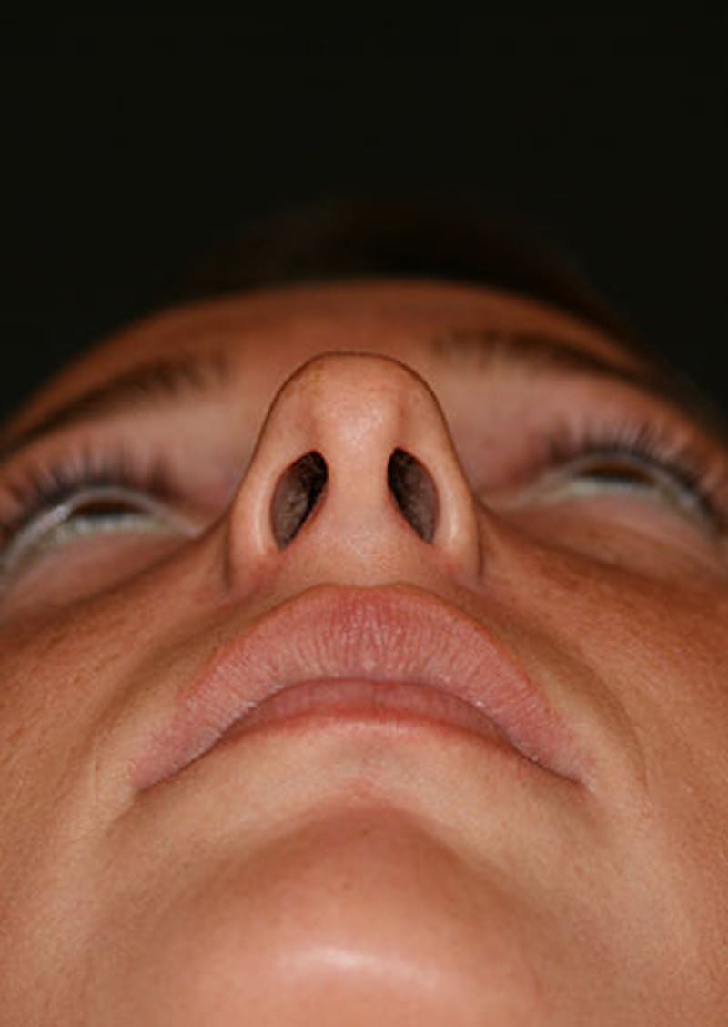 Rhinoplasty Before & After Gallery - Patient 106569149 - Image 11