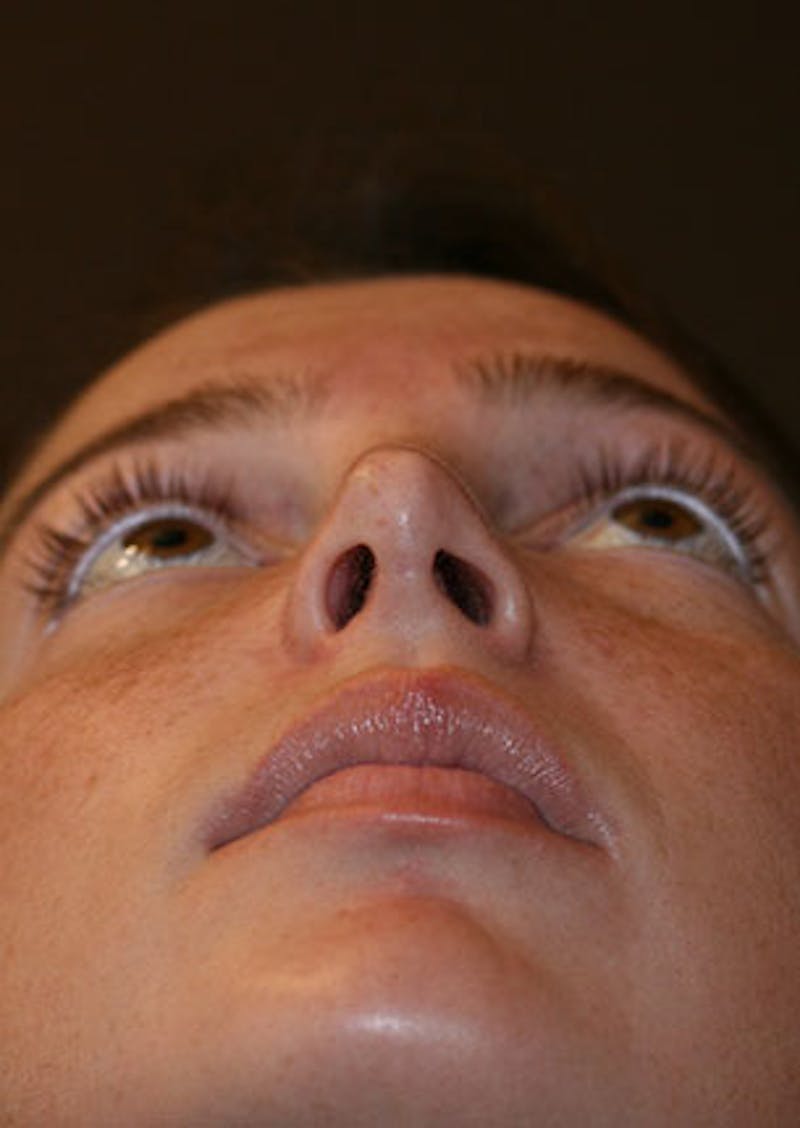 Rhinoplasty Before & After Gallery - Patient 106569149 - Image 12