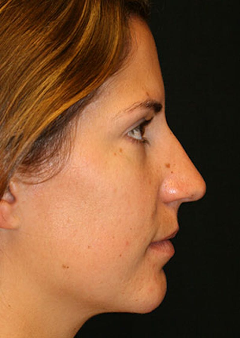 Rhinoplasty Before & After Gallery - Patient 106569165 - Image 1