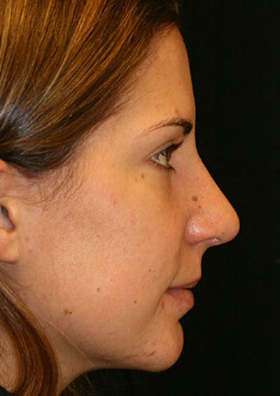 Rhinoplasty Before & After Gallery - Patient 106569165 - Image 2