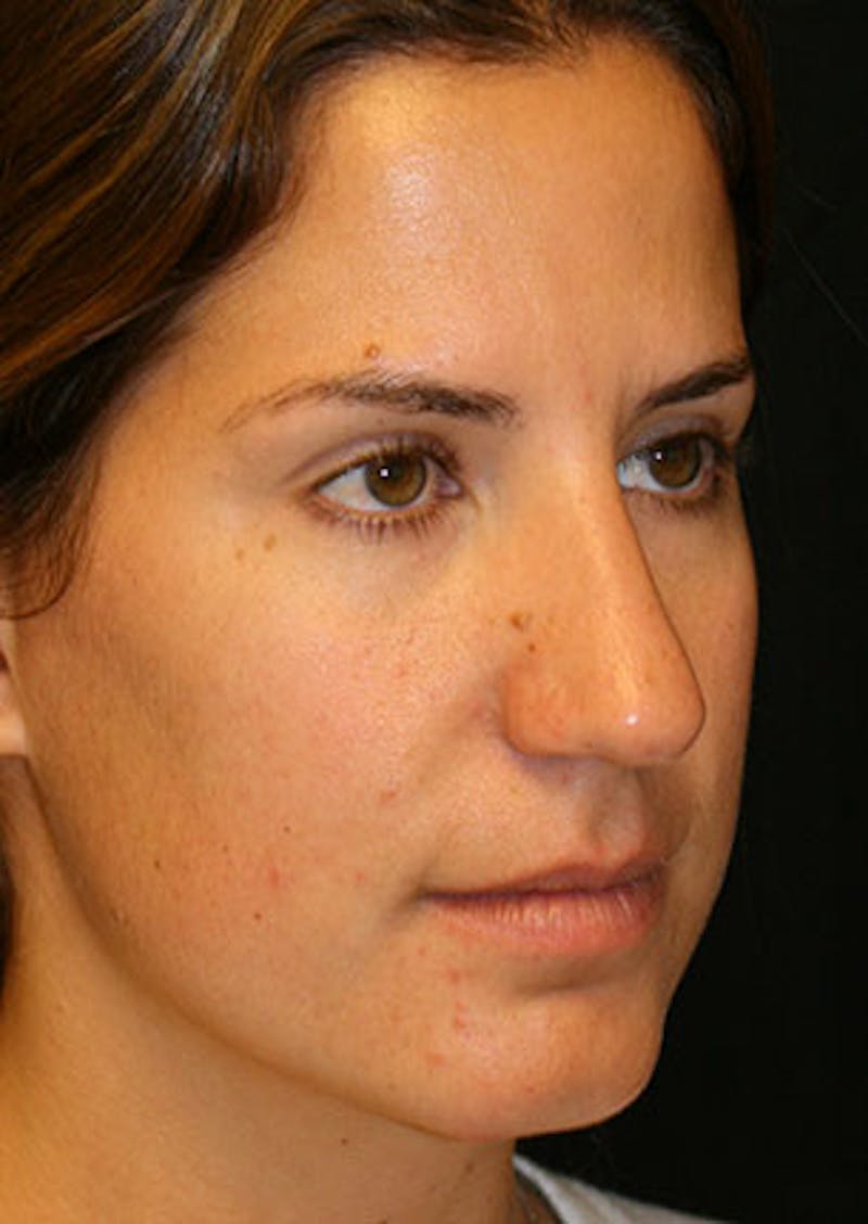 Rhinoplasty Before & After Gallery - Patient 106569165 - Image 3