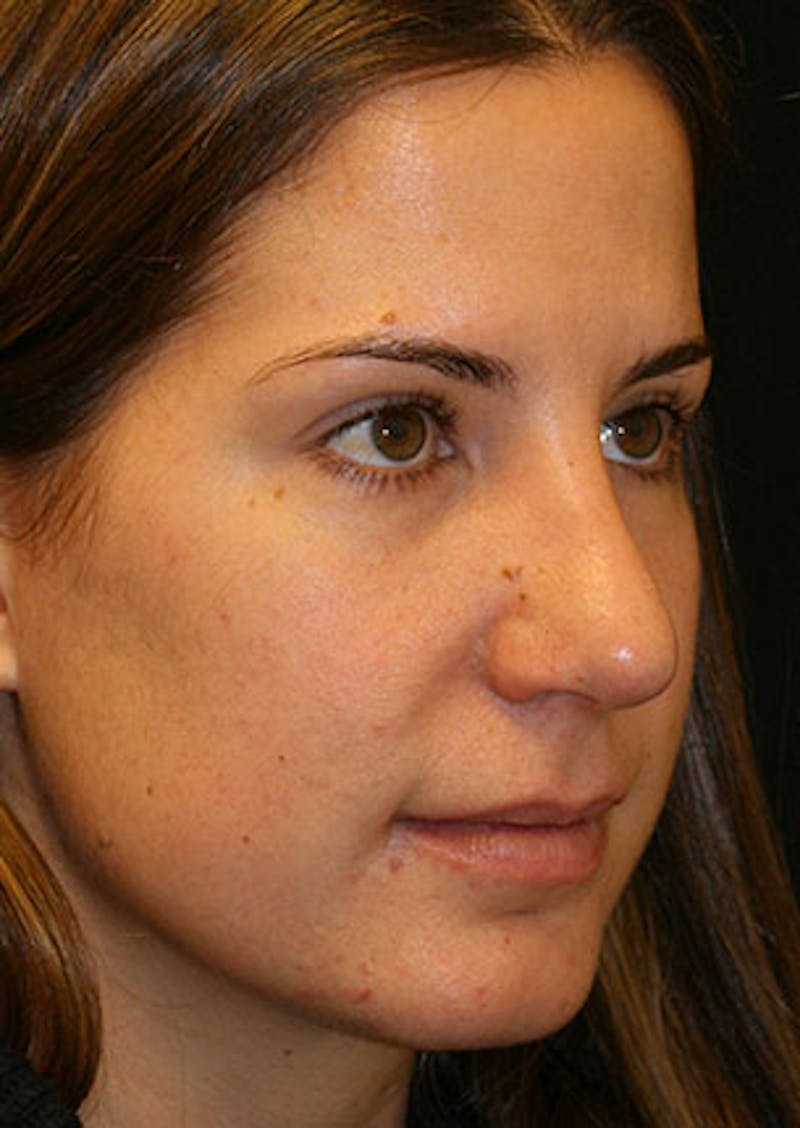 Rhinoplasty Before & After Gallery - Patient 106569165 - Image 4