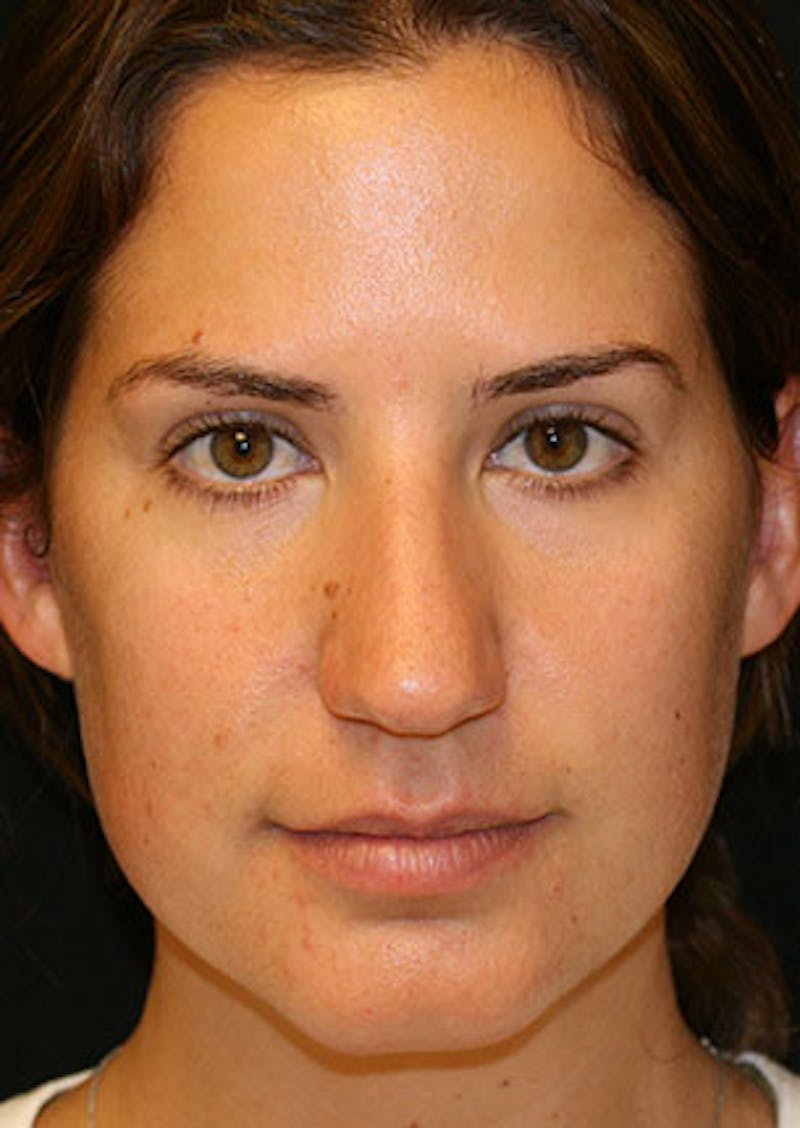 Rhinoplasty Before & After Gallery - Patient 106569165 - Image 5