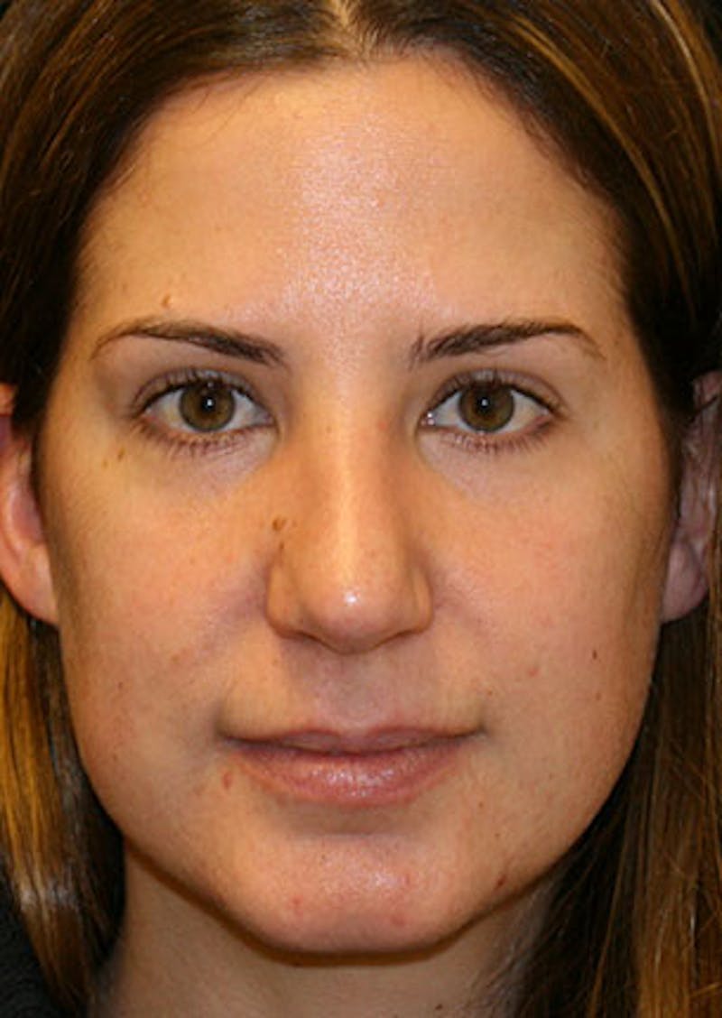 Rhinoplasty Before & After Gallery - Patient 106569165 - Image 6