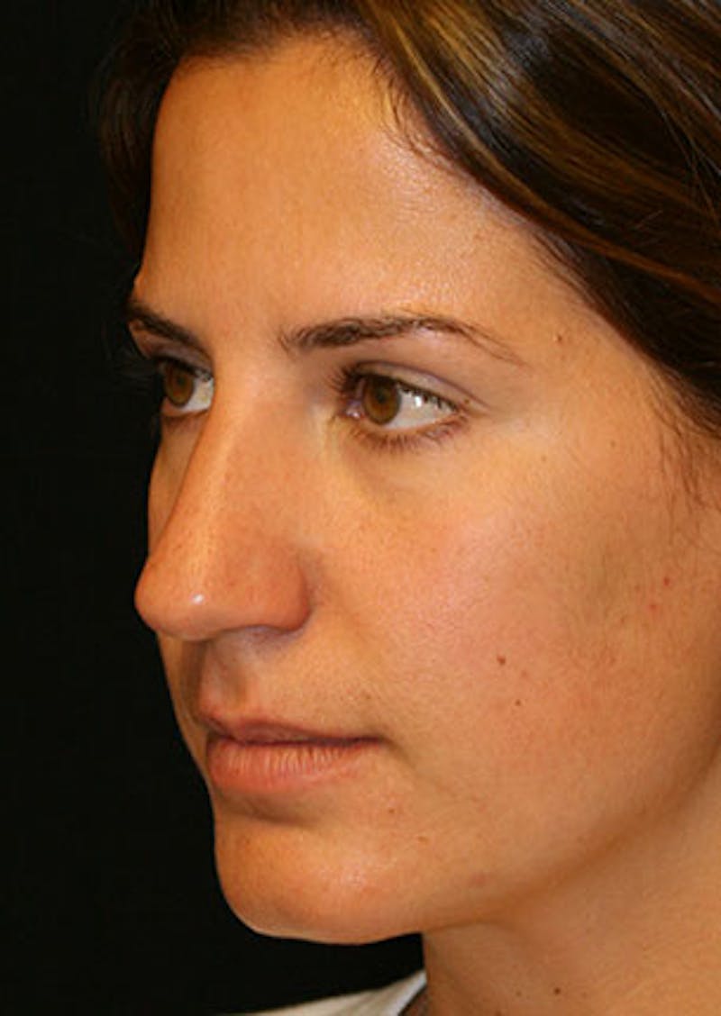 Rhinoplasty Before & After Gallery - Patient 106569165 - Image 7