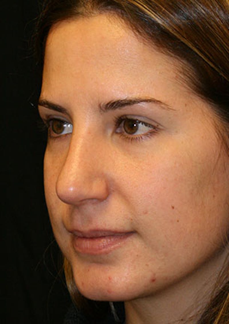 Rhinoplasty Before & After Gallery - Patient 106569165 - Image 8