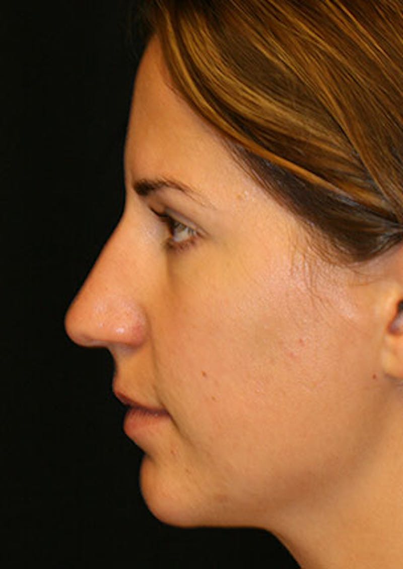Rhinoplasty Before & After Gallery - Patient 106569165 - Image 9