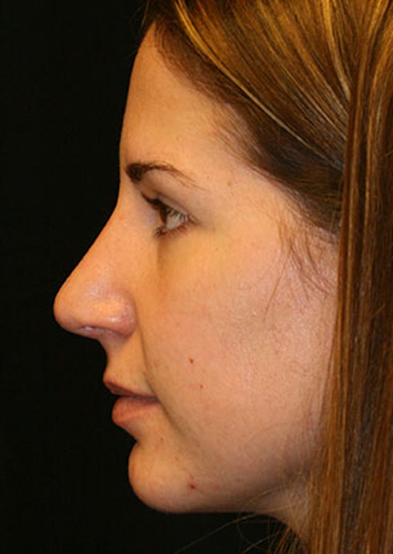 Rhinoplasty Before & After Gallery - Patient 106569165 - Image 10