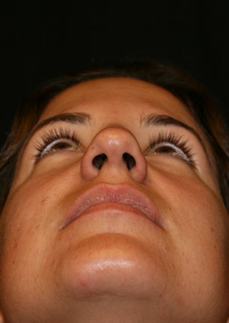 Rhinoplasty Before & After Gallery - Patient 106569165 - Image 11