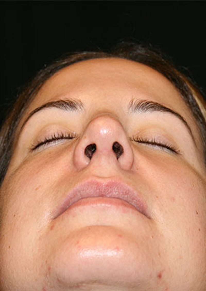 Rhinoplasty Before & After Gallery - Patient 106569165 - Image 12