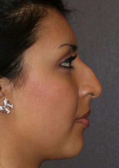 Rhinoplasty Before & After Gallery - Patient 106569189 - Image 1