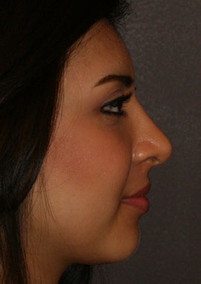 Rhinoplasty Before & After Gallery - Patient 106569189 - Image 2
