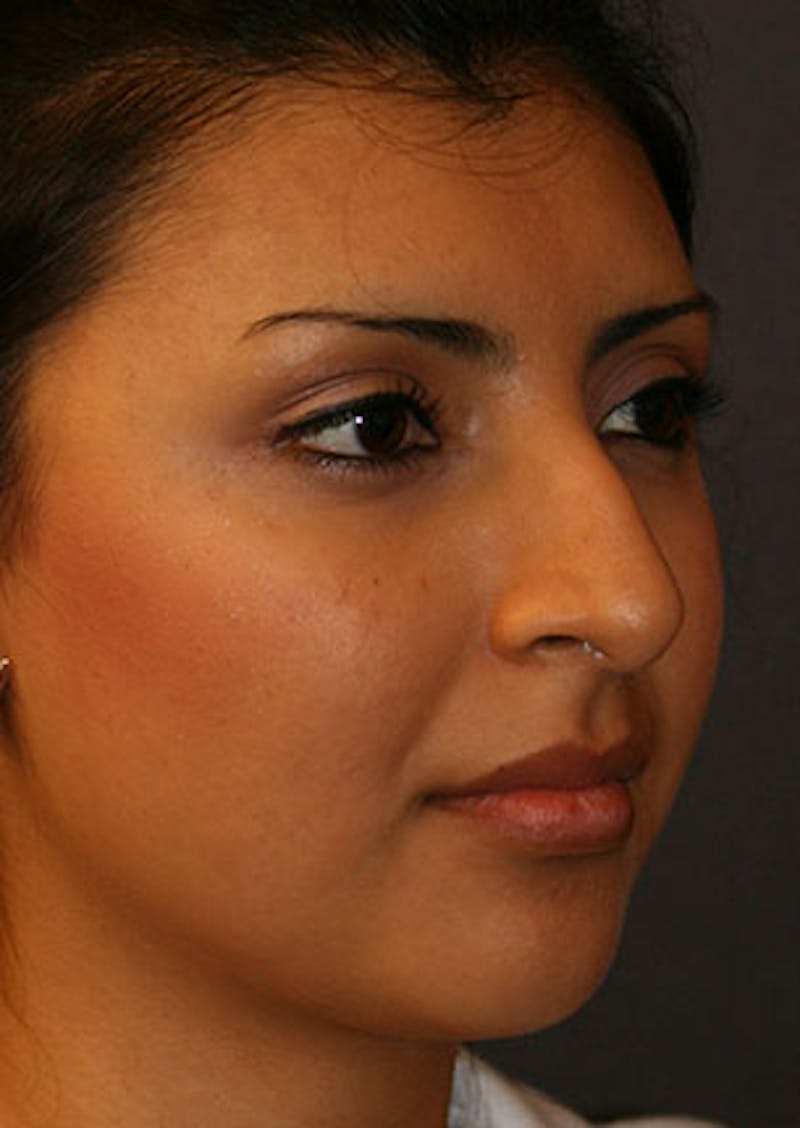 Rhinoplasty Before & After Gallery - Patient 106569189 - Image 3