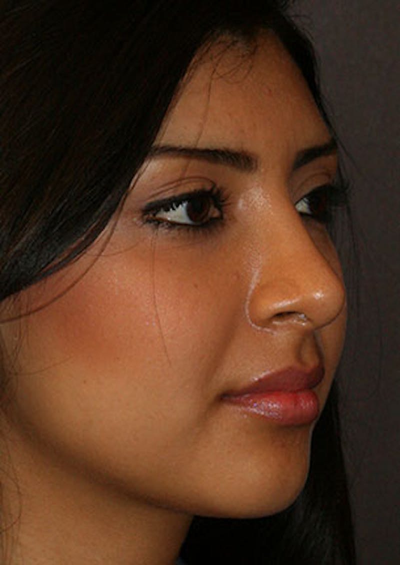Rhinoplasty Before & After Gallery - Patient 106569189 - Image 4