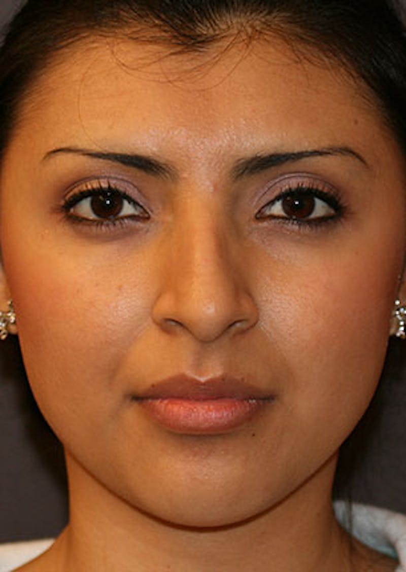 Rhinoplasty Before & After Gallery - Patient 106569189 - Image 5