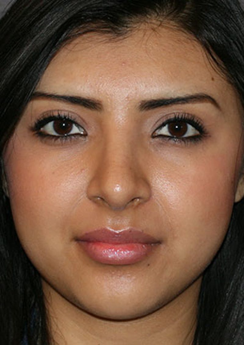 Rhinoplasty Before & After Gallery - Patient 106569189 - Image 6