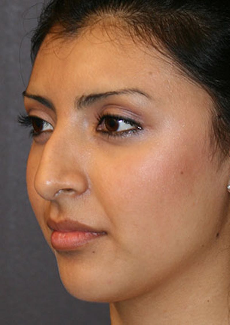 Rhinoplasty Before & After Gallery - Patient 106569189 - Image 7