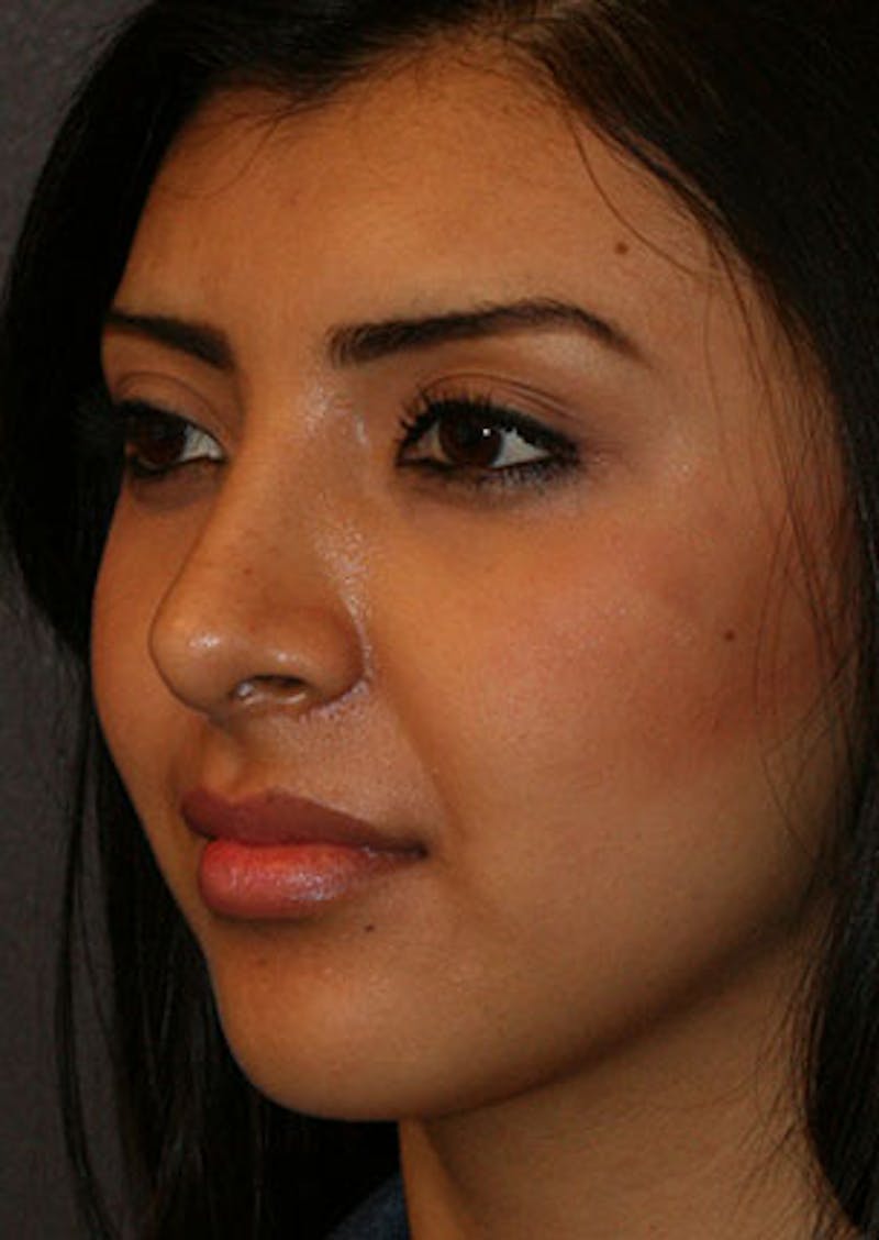 Rhinoplasty Before & After Gallery - Patient 106569189 - Image 8