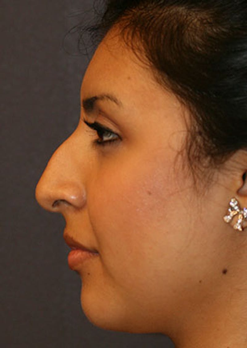 Rhinoplasty Before & After Gallery - Patient 106569189 - Image 9