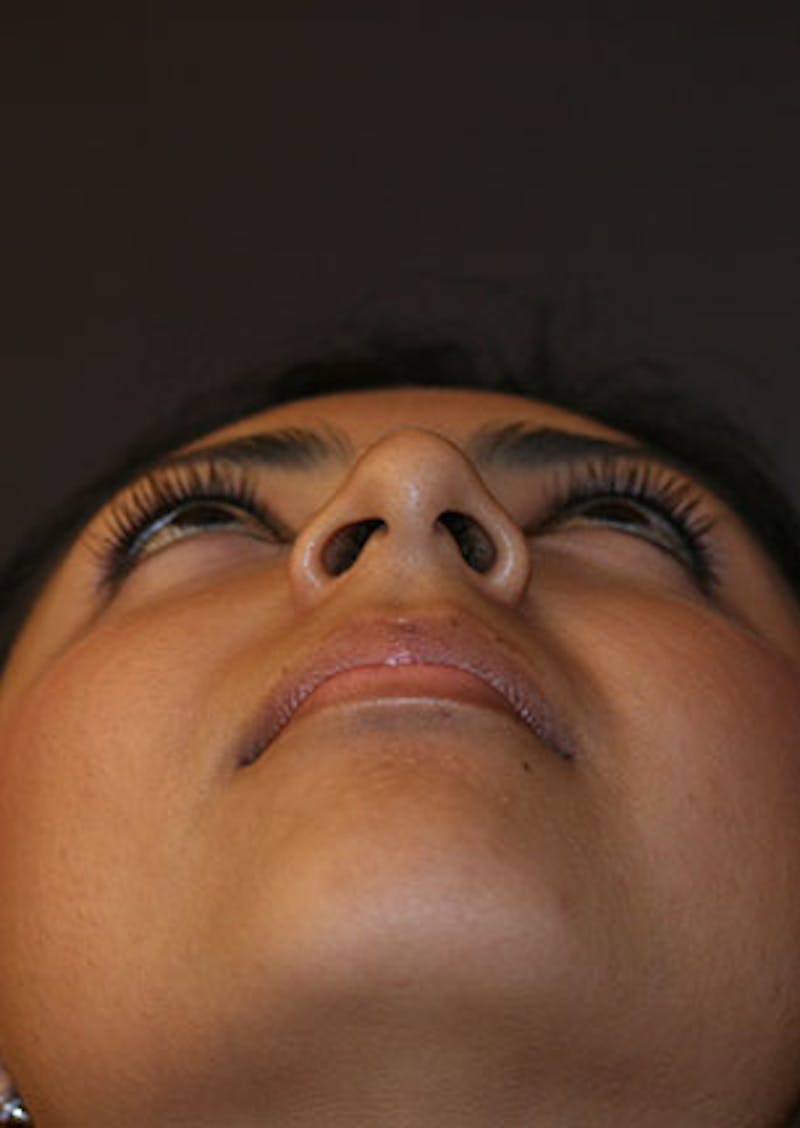 Rhinoplasty Before & After Gallery - Patient 106569189 - Image 11