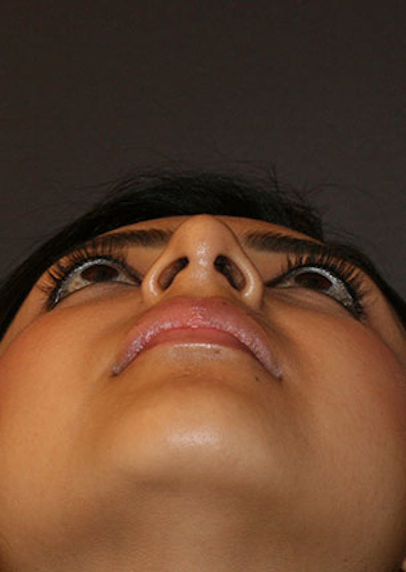 Rhinoplasty Before & After Gallery - Patient 106569189 - Image 12