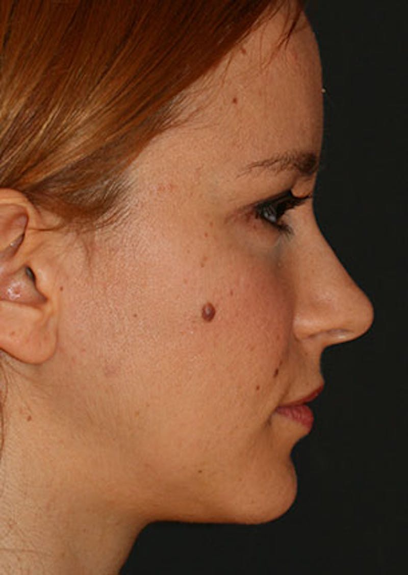 Rhinoplasty Before & After Gallery - Patient 106569190 - Image 1