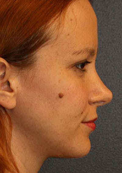 Rhinoplasty Before & After Gallery - Patient 106569190 - Image 2