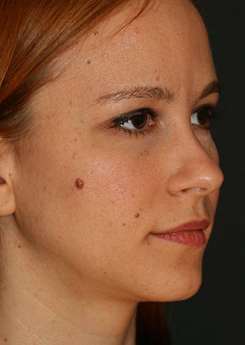 Rhinoplasty Before & After Gallery - Patient 106569190 - Image 3