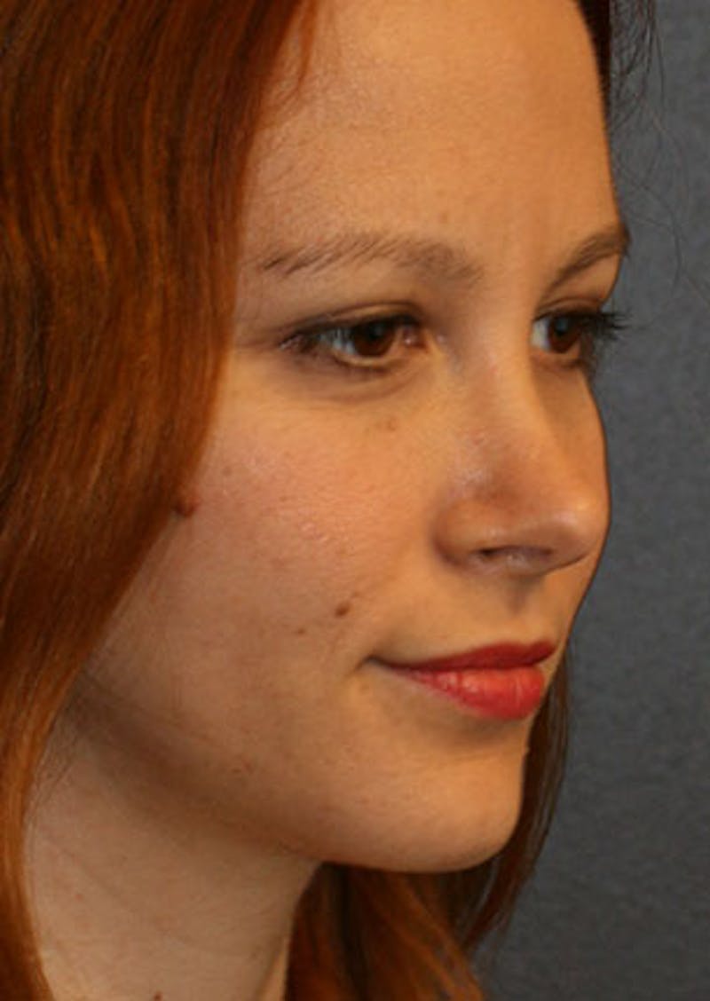 Rhinoplasty Before & After Gallery - Patient 106569190 - Image 4
