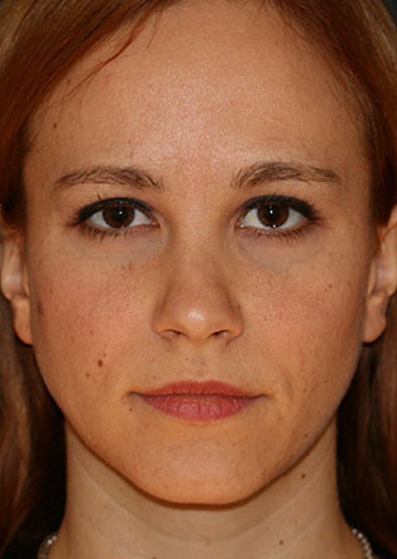 Rhinoplasty Before & After Gallery - Patient 106569190 - Image 5