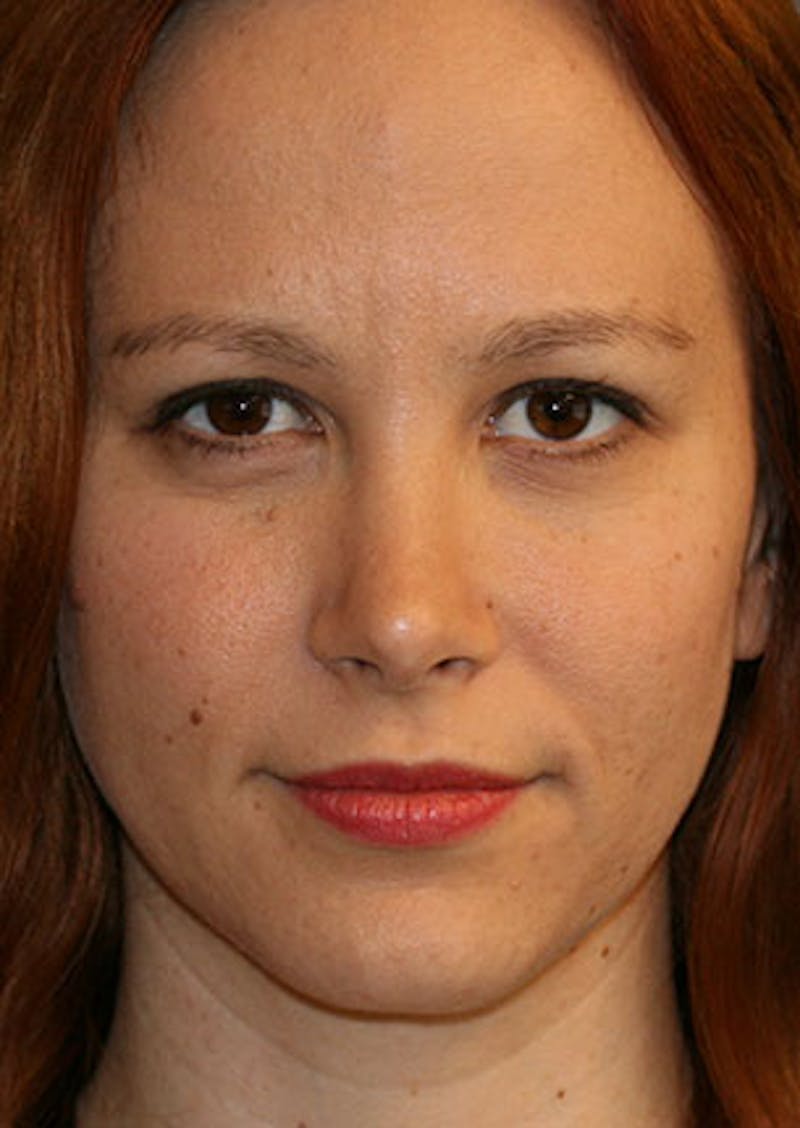 Rhinoplasty Before & After Gallery - Patient 106569190 - Image 6
