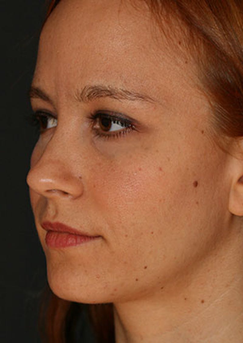 Rhinoplasty Before & After Gallery - Patient 106569190 - Image 7