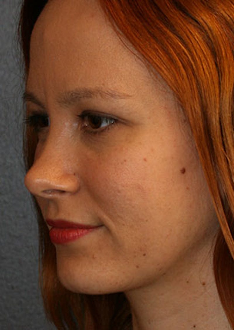 Rhinoplasty Before & After Gallery - Patient 106569190 - Image 8