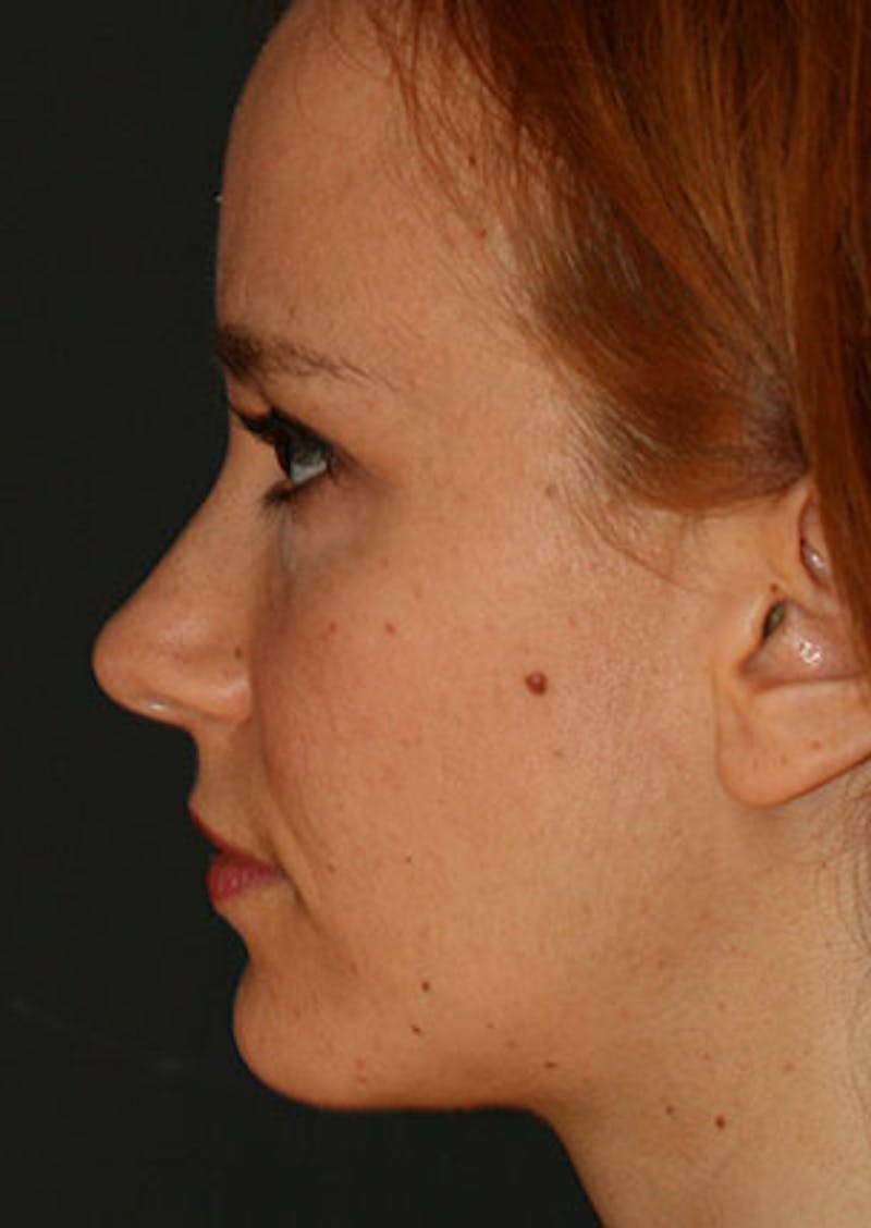 Rhinoplasty Before & After Gallery - Patient 106569190 - Image 9