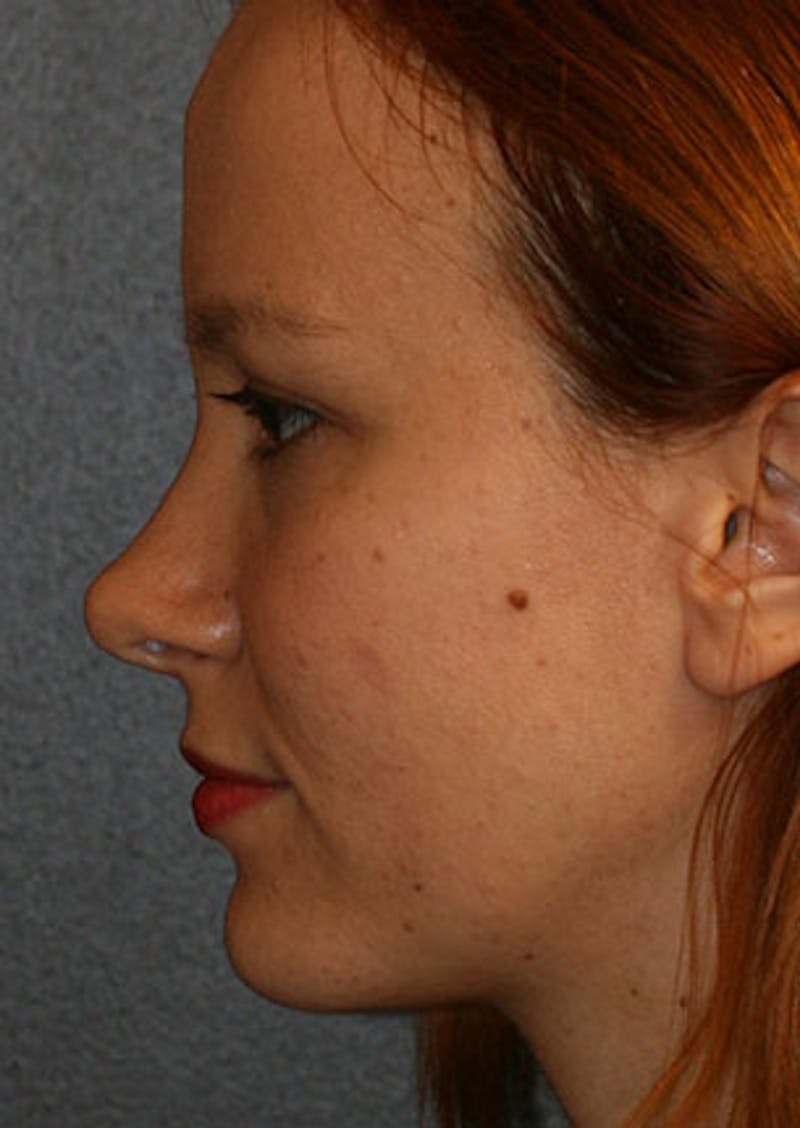 Rhinoplasty Before & After Gallery - Patient 106569190 - Image 10