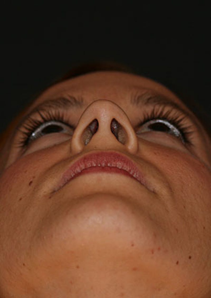 Rhinoplasty Before & After Gallery - Patient 106569190 - Image 11