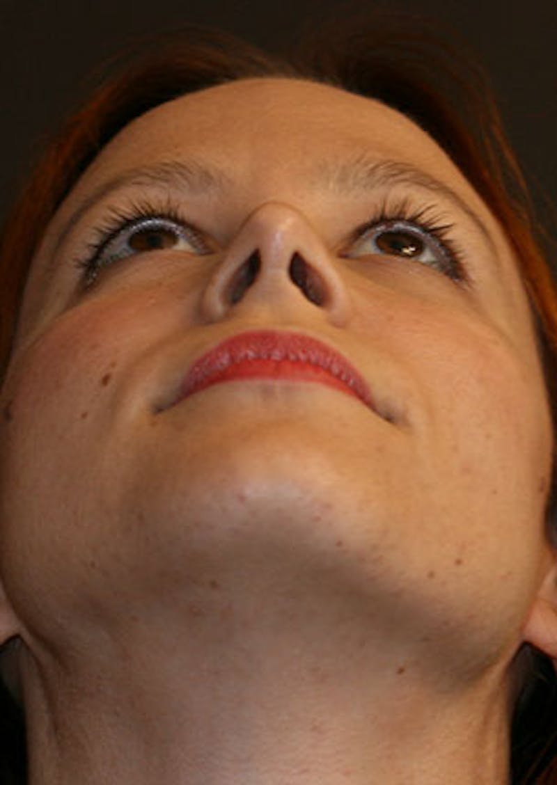 Rhinoplasty Before & After Gallery - Patient 106569190 - Image 12