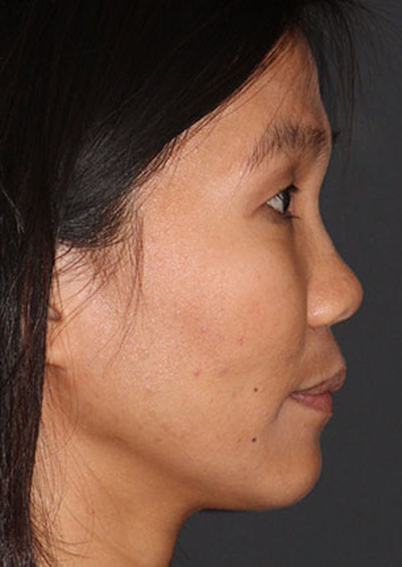 Rhinoplasty Before & After Gallery - Patient 106569196 - Image 1