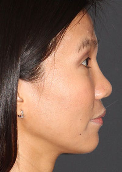 Rhinoplasty Before & After Gallery - Patient 106569196 - Image 2